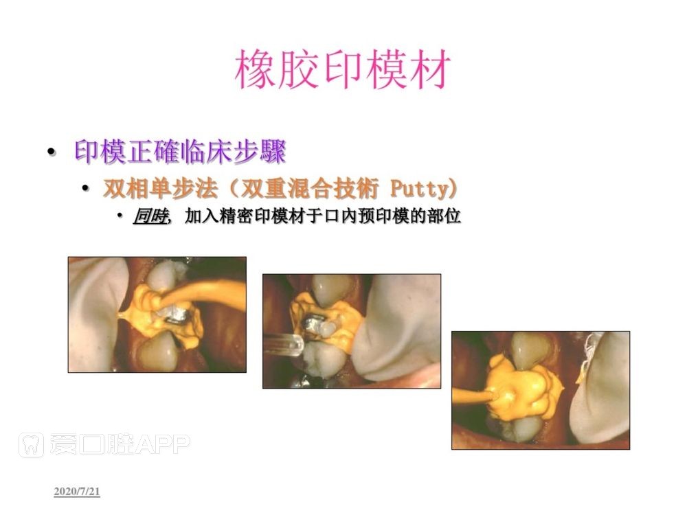 牙体预备和精确取模型 (122).jpg