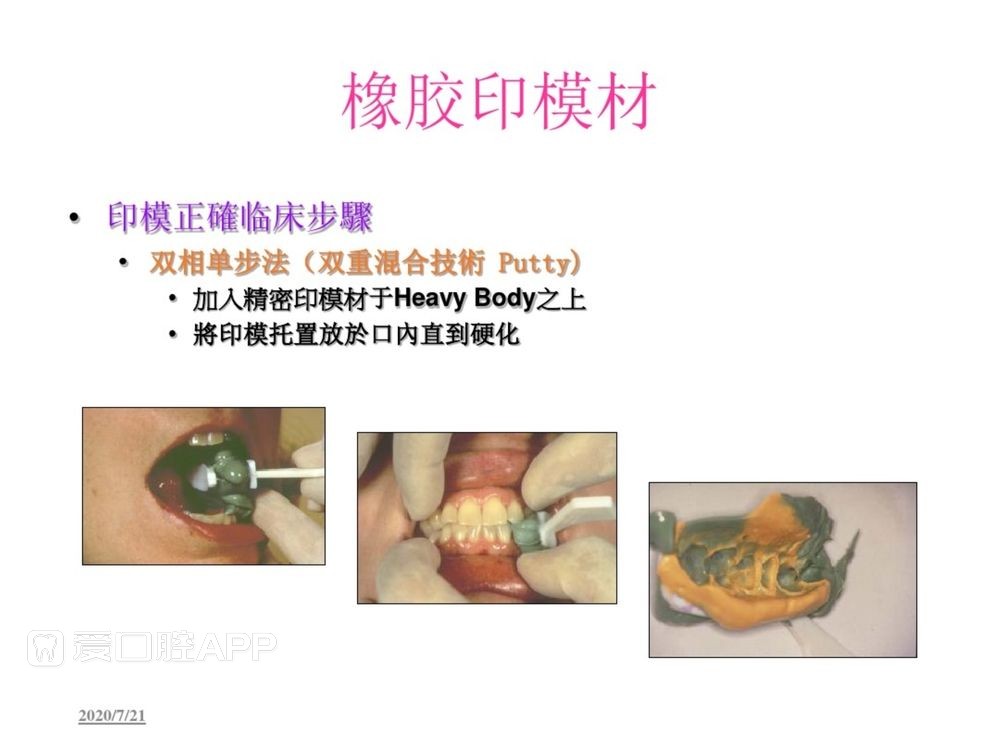 牙体预备和精确取模型 (123).jpg