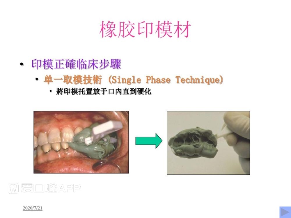 牙体预备和精确取模型 (125).jpg